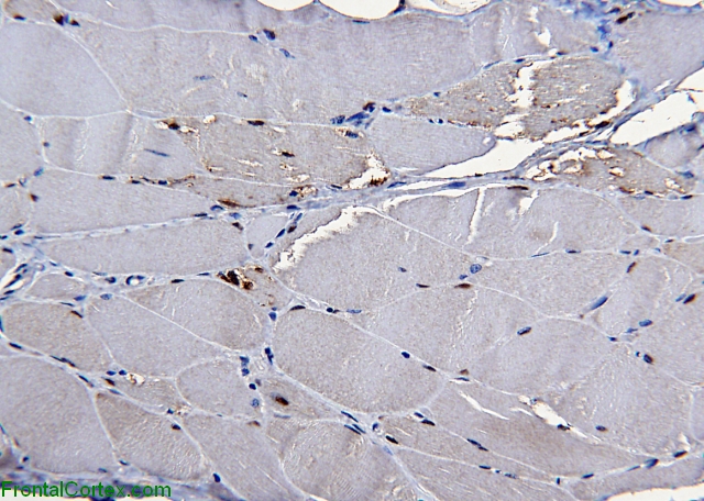 Inclusion body myositis, SMI-31 immunohistochemical staining x200